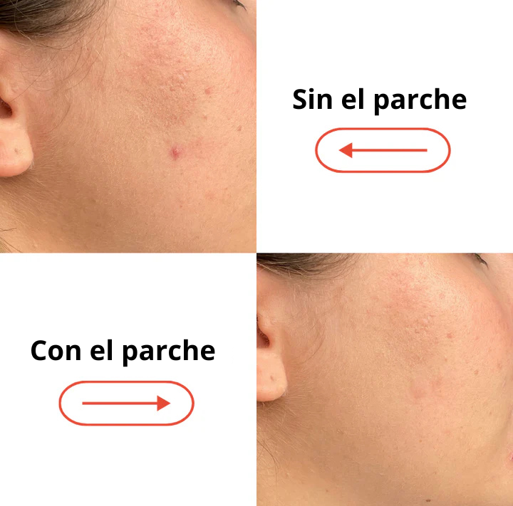 Parches Anti-Imperfecciones Skinout (x36)